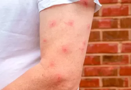 حقائق مرعبة .. لهذا السبب يختار البعوض بعض الناس ولا يقترب من أخرين !!