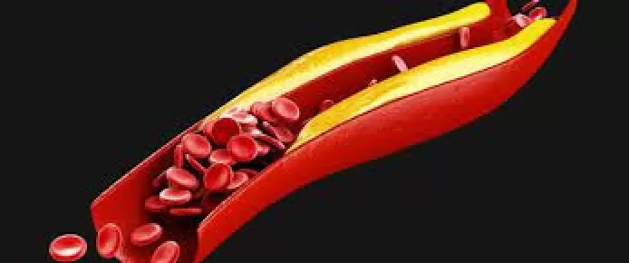 علامات على الفخذين تشير الى ارتفاع الكوليسترول في جسمك لمستويات خطيرة