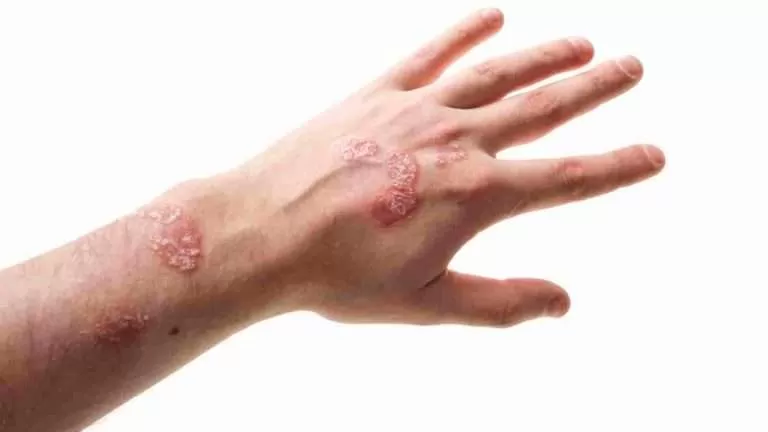 مفعولها يفوق الكريمات.. علاجات طبيعية وفعالة للإكزيما المزمنة