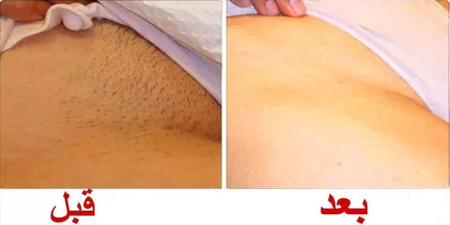 الخلطة السحرية لتفتيح المناطق الحساسة الداكنة لتتحول للون الوردي والأبيض