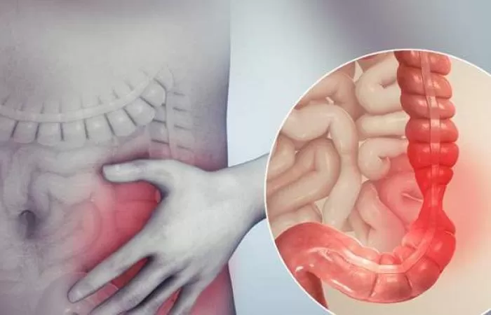 التخلص من القولون العصبي في 3 دقائق نهائياً بطريقة طبيعية دون أي أدوية !!..