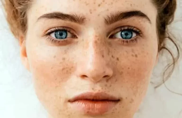 من مطبخك .. علاجات طبيعية تخلصك من النمش بنتائج مذهلة وبدون تكاليف