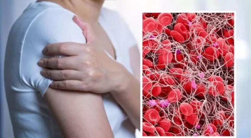 احذر.. اذا ظهرت هذه الأربع العلامات على ذراعك فهي تدل على انك تعاني من تجلط الدم .. هذا مايجب عليك فعله فورا ؟