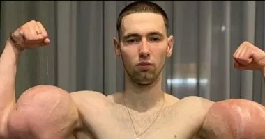 استخدم الفازلين لتضخيم هذا الجزء العضلي من جسده فحصل له ما لم يكن في الحسبان والصور صادمة