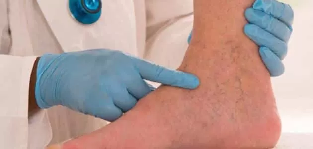 سبب لا تتوقعه يسبب جلطة الساق التي قد تسبب قطعها!!