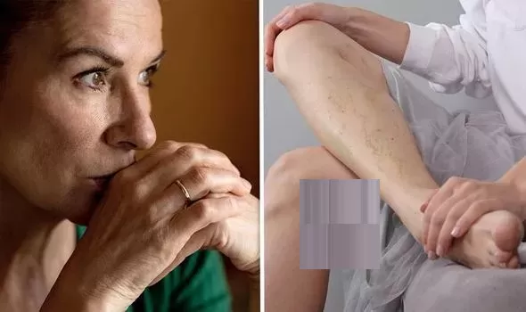 علامات واضحة في الساقين تدل على جلطة خطيرة ستحدث في جسمك احذرها