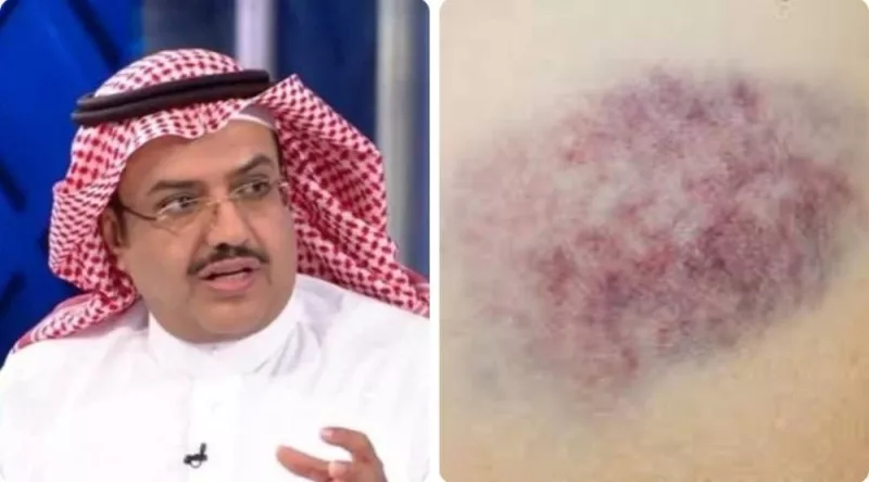 هل ظهور كَدَمات زرقاء في الذراع والساقين عند النساء وكبار السن أمر خطير “النمر” يجيب ويكشف الأسباب