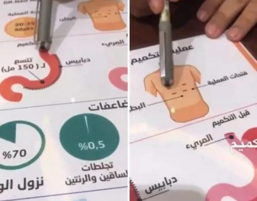 فيديو يشرح طريقة تكميم المعدة لانقاص الوزن