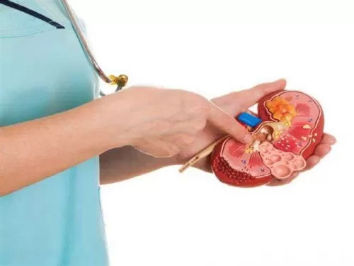 ليس بالضرورة أن تشعر بالألم.. مؤشرات تنذر بحصوات الكلى