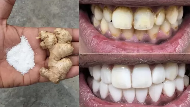 وصفة بسيطة لم يسمع عنها احد من قبل لتبييض الأسنان خلال ساعات فقط والتخلص من الجير والاصفرار نهائياً