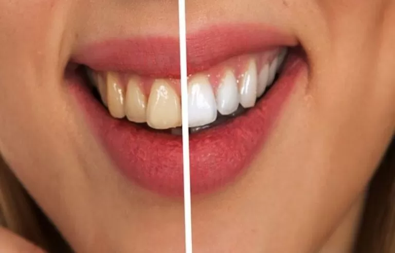 اشياء لا تتوقعها تسبب اصفرار اسنانك وتأكلها