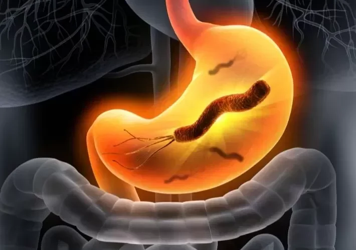 علاج نهائي يقضي على جرثومة المعدة