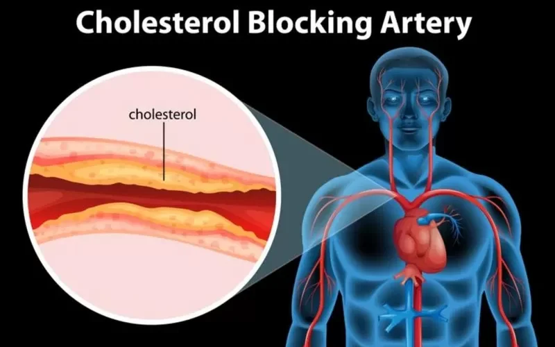 اربع علامات في مناطق مختلفة من الجسم تقول ان جسمك يستغيث بسبب ارتفاع خطير في الكوليسترول