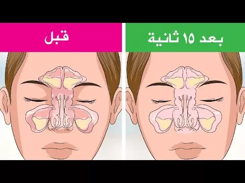 علاج انسداد الانف والتهاب الجيوب الأنفية في 15 ثانية فقط أسهل الطرق لعلاج الزكام في بيتك وبدون أدوية