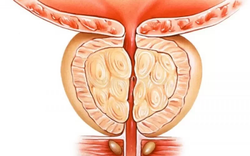 ما هي التهابات البروستاتا؟ وما هي اعراض التهاب البروستاتا؟ وكيف تدمر حياتك الجنسية؟