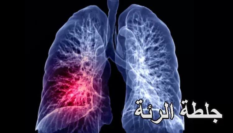 جلطة الرئة؛ تعرف على أهم أسبابها وأعراضها وطرق التشخيص والعلاج !!