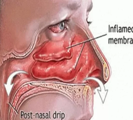هذا المشروب علاج طبيعي لانسداد الجيوب الأنفية واعراض نزلات البرد والزكام