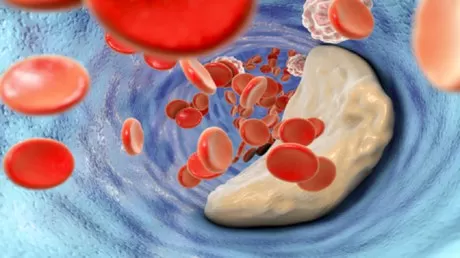 طرق سهلة لخفض مستويات الدهون الضارة في الدم