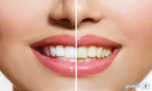وصفة طبيعية لتبييض الأسنان في البيت بمكونات طبيعية 100% خلال ثواني