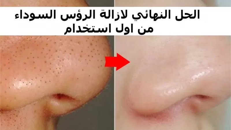 ودعي الرؤوس السوداء.. ماسك الفحم والجيلاتين لوجه مشرق وصافي والنتيجة من اول استخدام !!..