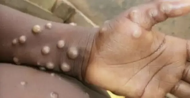 رسمياً: جدري القرود يصل مصر ويضرب هذه المناطق .