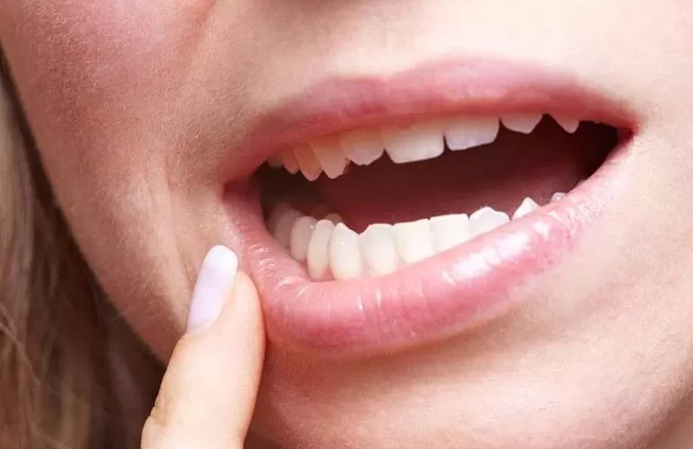إحذر .. ظهور هذه العلامتان في الفم تُنبهك لإرتفاع نسبة السكر في الدم بشكل خطير ’’تعرف عليها’’ !!