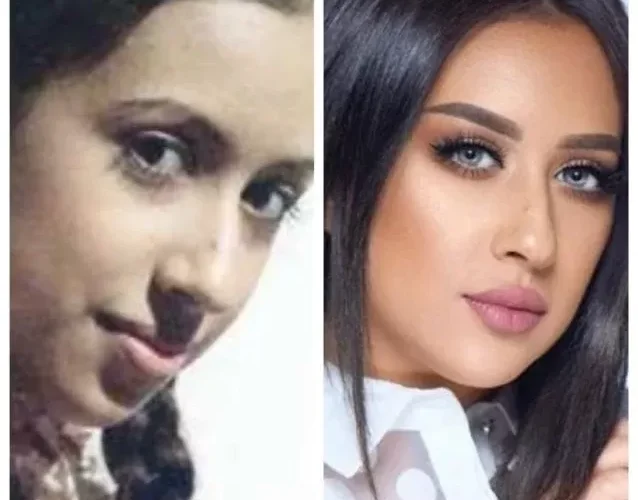 بحواجبها المرعبة .. شاهد فرح الهادي كيف تشوهت بسبب عملية تجميل خاطئة.