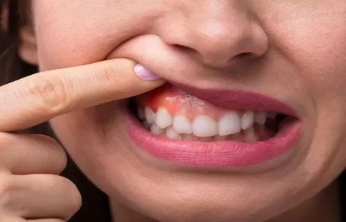 أسباب تراجع اللثة.. والعلاج الطبيعي المتوافر بسهولة