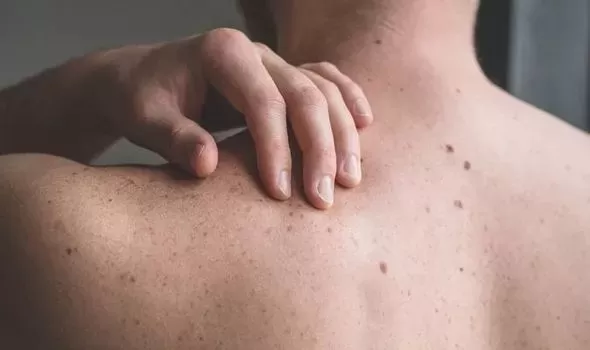 علامات تظهر في الجلد سببها الوحيد ارتفاع الكوليسترول في الدم لمستوى خطير