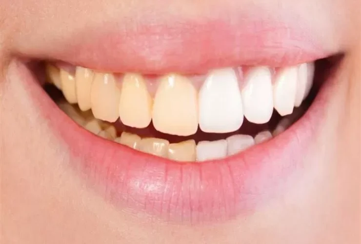 وصفة الملح الرهيبة لتبييض اسنانك تخليها بيضاء زي الحليب خلال دقائق فقط