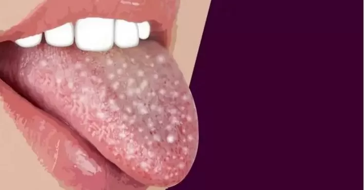 علامات تظهر على اللسان تؤكد الاصابة بسرطان الفم واللثة