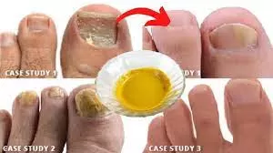 علاج منزلي يخلصك من فطريات القدمين في ليلة واحدة