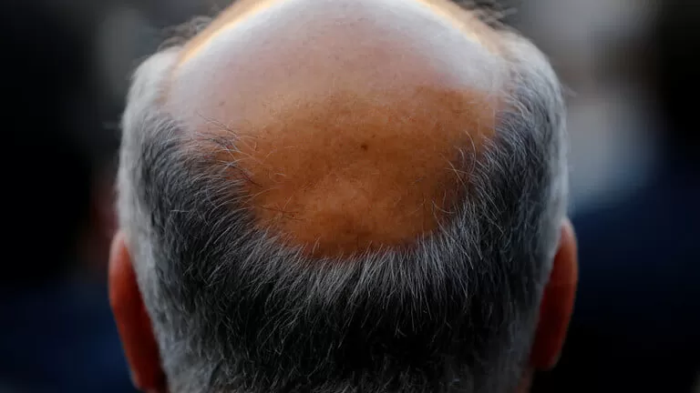 الوصفة المعجزة للقضاء على الصلع وانبات الشعر خلال خمسة عشر يوم فقط