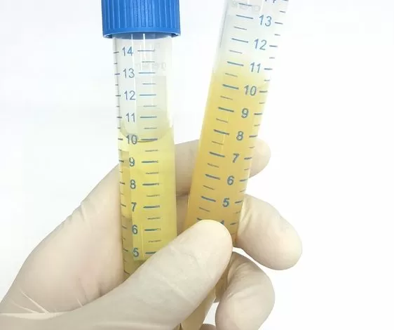 علامات في البول تشير الى الاصابة باخطر انواع السرطان واكثرها فتكاً بالرجال