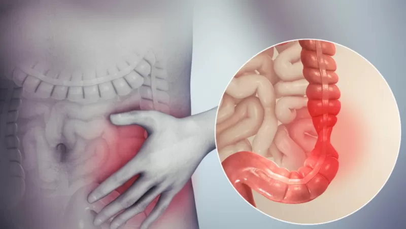 وداعاً للأدوية.. طرق بسيطة للغاية لعلاج القولون العصبى جربها الآن وعش مرتاح البال