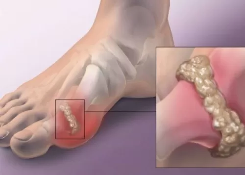 ما لا تعرفه عن داء الملوك.. أعراضه وعوامل الإصابة به