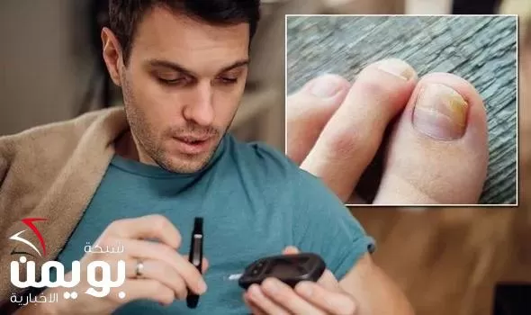 انظر الى اظافرك وبهذه العلامات ستعرف اذا كان السكري مرتفع ام لا