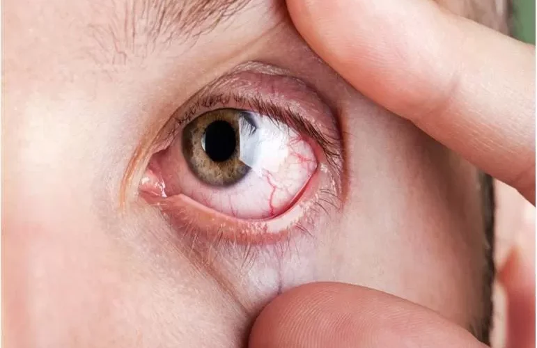 احذر من اعراض سرطان العيون وهذه هي اسبابه