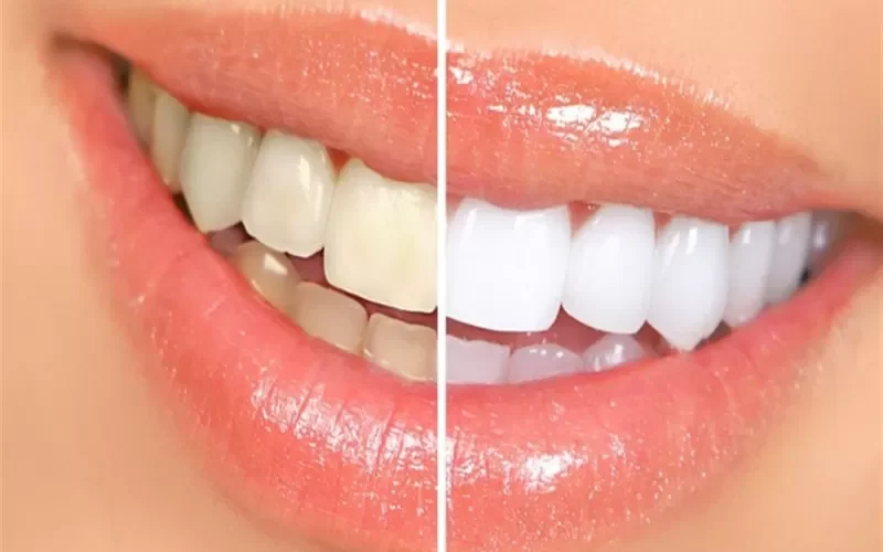 هذه الطريقة حيرت أطباء الأسنان.. تبييض الأسنان بسرعة الصاروخ بمكون واحد سحرى فى 3 دقائق بدون تكاليف و بديل لليزر !!