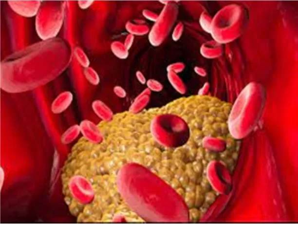 ارتفاع الكوليسترول القاتل يظهر في علامات واضحة على هذه المناطق في الوجه راقبها دائماً