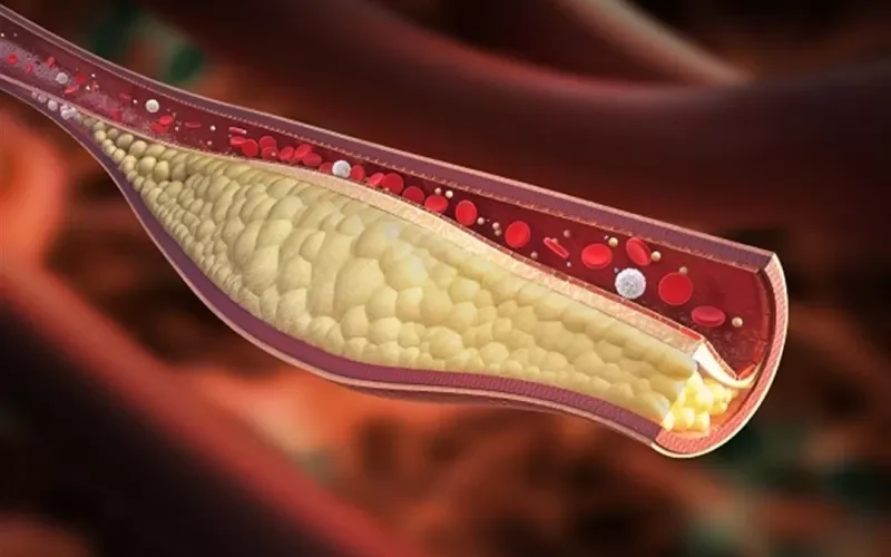 احذر من هذه العلامات الواضحة على ارتفاع نسبة الكوليسترول الضار في الجسم !