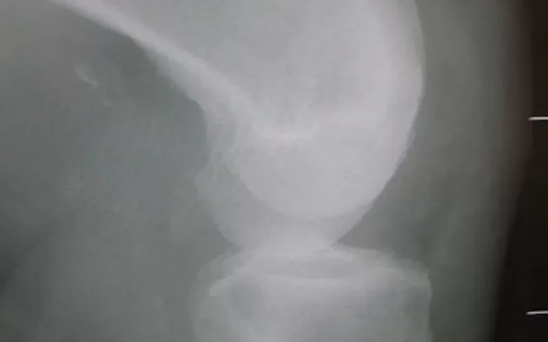 هل تمزق اربطة الركبة خطير ؟ وهل يمكن علاج تمزق اربطة الركبة ؟