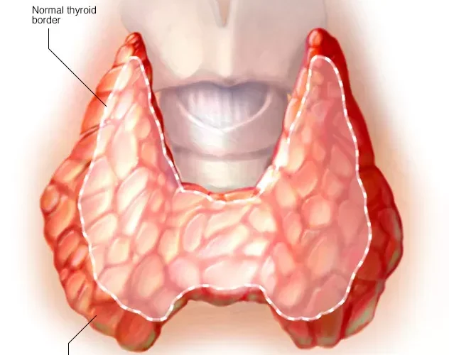 امــراض تسبب تضخـم الغدة الدرقية وهذه هي مخـاطر استمرار تضخمها!