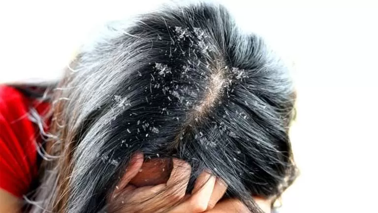 خلطة طبيعية رهيبة للقضاء على قشرة الشعر خلال ايام