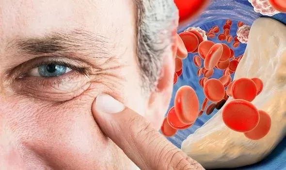 علامات واضحة حول العيون تؤكد وصول الكوليسترول في الدم الى المستوى القاتل