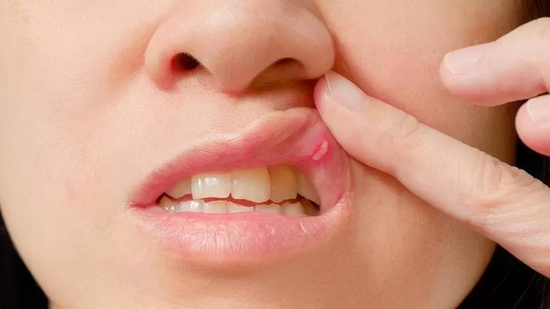 تقرحات الفم واللسان تكون قاتلة في هذه الحالات