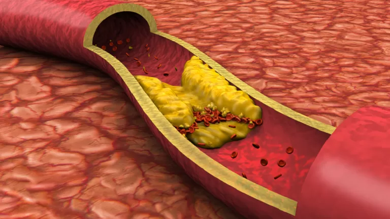بدون ادوية.. اطعمة رخيصة الثمن تعالج ارتفاع الكوليسترول في وقت قياسي وبدون اثار جانبية