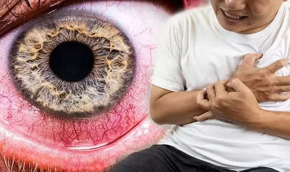 3 علامات يجب أن تلاحظها في عينيك تحذر من ارتفاع مستويات الكوليسترول بشكل خطير؟