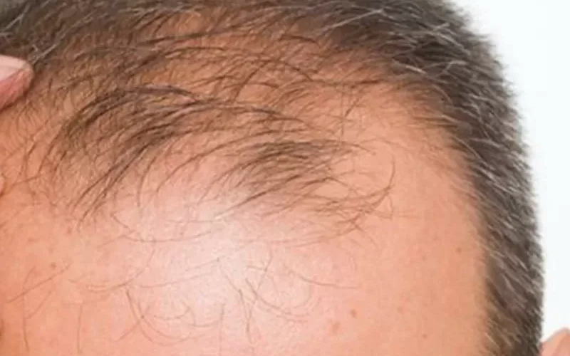 لهذه الأسباب فإن الرجل الأصلع اكثر فحولة ورجولة