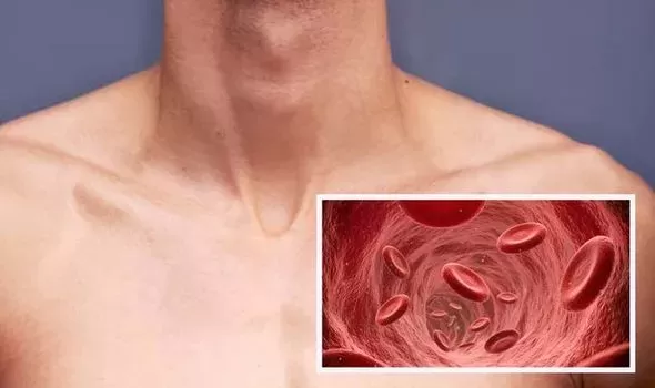 علامات واضحة تظهر  في جلدك وصدرك وساقيك تشير إلى جلطة قريبة قاتله .. يجب مراقبتها